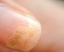 Infezioni fungine delle unghie, caratteristiche e cura